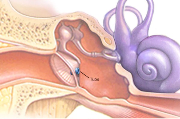 Ống thông màng nhĩ (Tube), đã được đặt xuyên qua màng nhĩ, nhằm dẫn chất dịch từ tai giữa ra ngoài