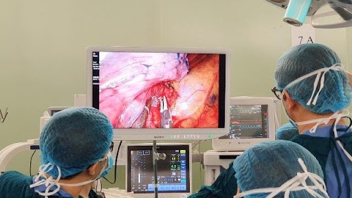 Phẫu thuật viên đang tiến hành cắt thùy phổi bằng phẫu thuật nội soi