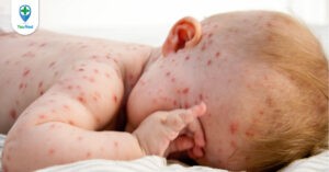 Trẻ sơ sinh bị thủy đậu: nguyên nhân, triệu chứng và cách điều trị