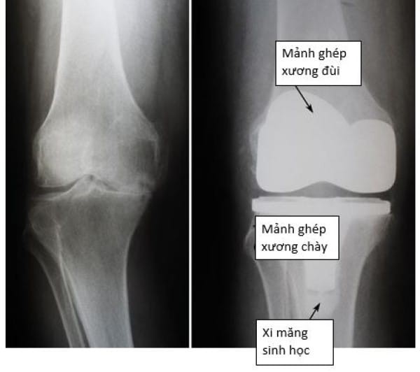 Bên trái: hình ảnh X- quang khớp gối thoái hoá nặng. Bên phải: hình X-quang của thay khớp gối toàn phần, chú ý là mảnh ghép nhựa đặt ở giữa 2 mảnh ghép kim loại không nhìn thấy được trên X-quang