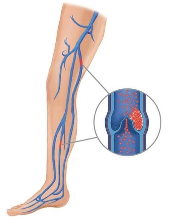 Cục máu đông có thể hình thành ở một trong những tĩnh mạch sâu của cơ thể. Các cục máu đông này có thể được tạo ra ở bất kỳ tĩnh mạch sâu nào, chúng thường được hình thành nhất ở các tĩnh mạch của xương chậu, bắp chân hoặc đùi.