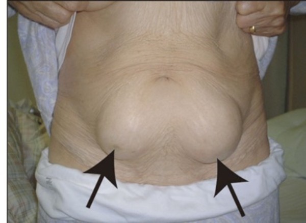 Loạn dưỡng mô mỡ kiểu phì đại ở bụng do tác dụng phụ khi dùng insulin không đúng cách (mũi tên màu đen)