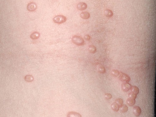 Đặc trưng của u mềm lây là những sẩn mụn nhỏ, hình tròn, hay bầu dục, thường gồ lên bề mặt da, trung tâm có lõm trắng, rất dễ chẩn đoán nhầm với các bệnh lý khác