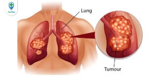 Những triệu chứng ung thư phổi giai đoạn cuối và mức độ nguy hiểm