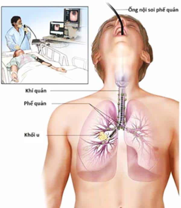 Nội soi phế quản giúp chẩn đoán ung thư phổi