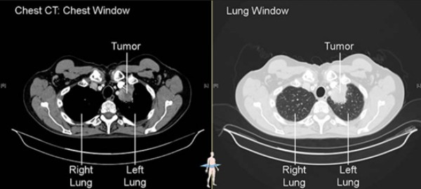 Khối bướu vùng đỉnh phổi trái (tumor)