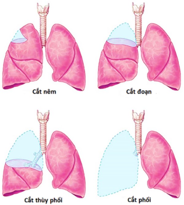 Các mức độ phẫu thuật trong ung thư biểu mô tuyến phổi.