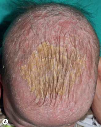 Tổn thương viêm da tiết bã trên da đầu một trẻ sơ sinh: vảy vàng dày kèm ban đỏ viêm, điển hình của “cradle cap”