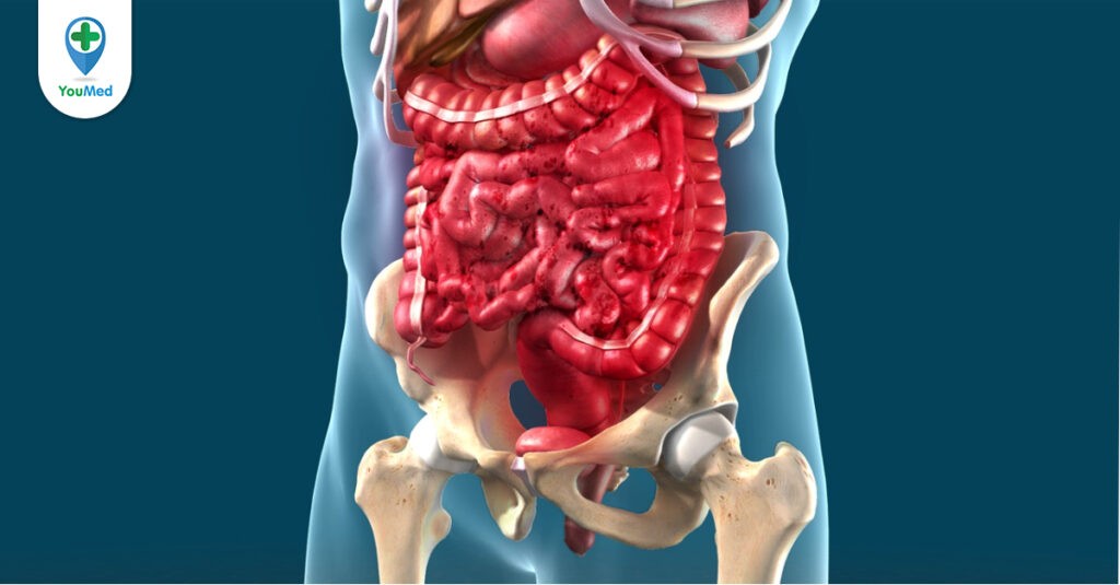 Viêm ruột (IBD): Nguyên nhân, triệu chứng và cách điều trị