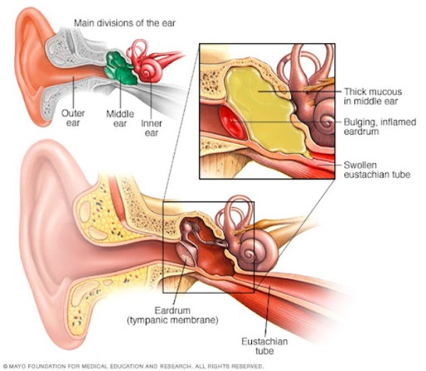 Tai ngoài (outer ear), tai trong (inner ear) và tai giữa (middle ear) bình thường (màu xanh lá) và khi viêm (thick mucus, màu vàng) với cấu trúc vòi nhĩ (Eustachian tube)