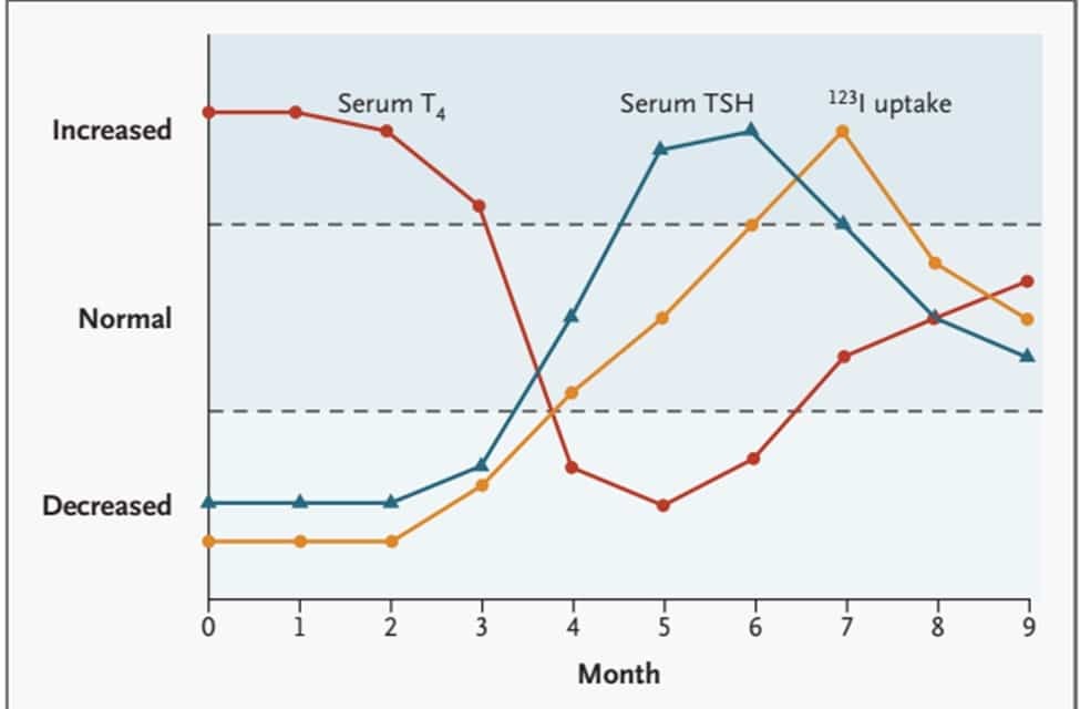 Các giai đoạn của viêm giáp bán cấp dựa trên xét nghiệm TSH, T4, độ hấp thu iod4