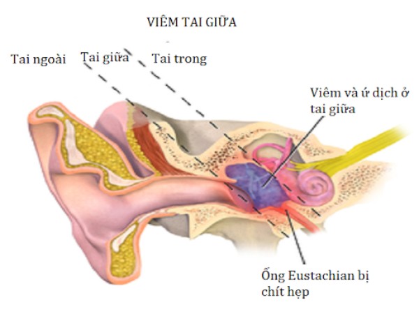 Vòi nhĩ bị tắc nghẽn trong bệnh viêm tai giữa
