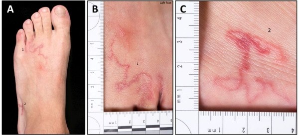Tổn thương da do ấu trùng giun đầu gai gây ra có thể gặp ở các vị trí khác nhau trên cơ thể.