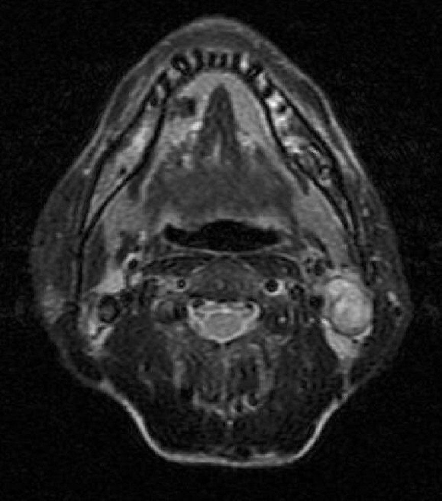 Hình MRI trên chuỗi xung T2 mô tả hạch cổ trái di căn từ ung thư vòm họng