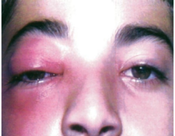 (Hình ảnh biến chứng viêm mô tế bào trước vách mắt phải với triệu chứng sưng nề quanh hốc mắt, ở mi mắt trên và dưới, thường do biến chứng của viêm xoang sàng