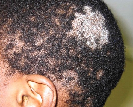 Một bé trai với biểu hiện nấm da đầu điển hình