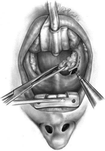 Phẫu thuật cắt amidan