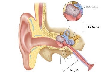 Khối cholesteatoma ở tai giữa