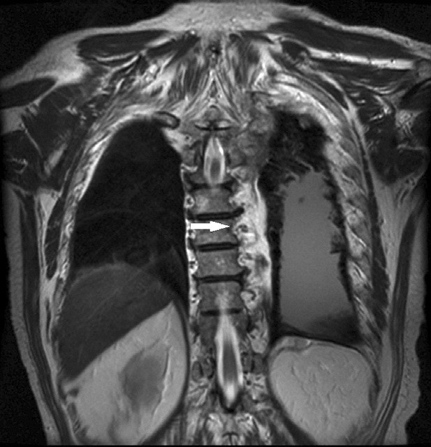 Có dày dính màng phổi cạnh trái và tràn dịch màng phổi (mũi tên) trên phim T2