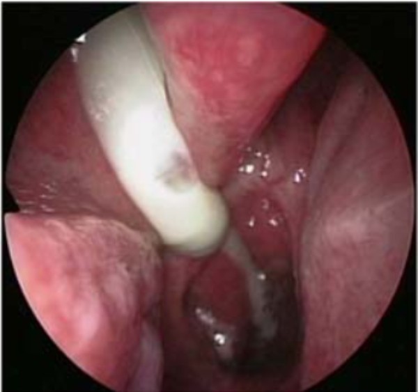 Hình ảnh dịch đục chảy ra từ khe mũi giữa bên phải, dẫn lưu xuống vòm họng. Chỉ dấu của viêm mũi xoang trên hình ảnh nội soi mũi