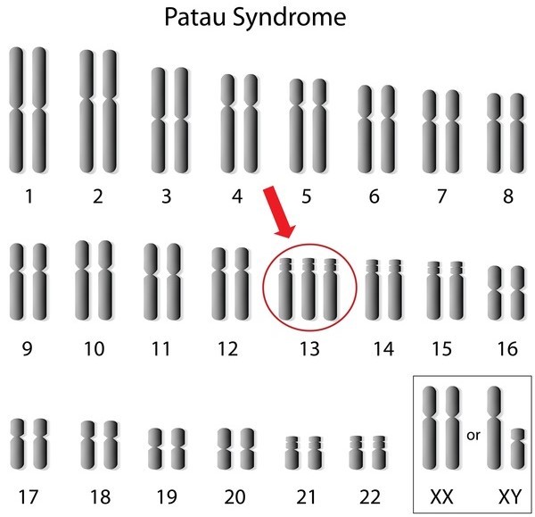 Hội chứng Patau là sự bất thường trong số lượng nhiễm sắc thể của cặp nhiễm sắc thể số 13