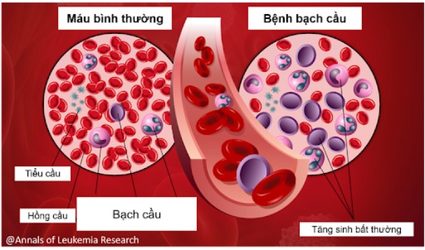  Mẫu máu của bệnh bạch cầu (bên phải) có số lượng các tế bào bạch cầu nhiều hơn bất thường so với mẫu máu bình thường (bên trái)