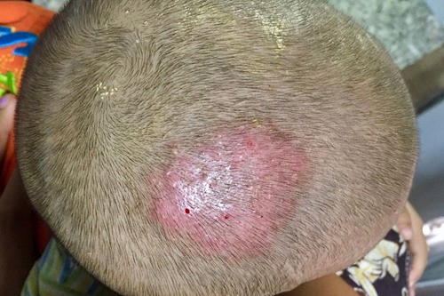 Kerion, hay là tổn thương viêm nặng của nấm da đầu sẽ để lại nhiều hậu quả nghiêm trọng, nên cần được chẩn đoán và điều trị sớm
