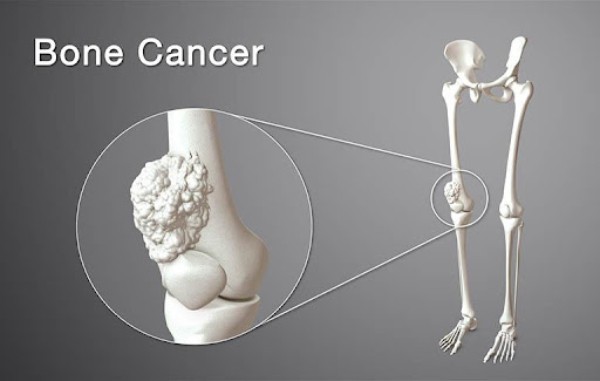 Một khối ung thư xương ở gần gối (đầu dưới xương đùi) trên hình mô phỏng