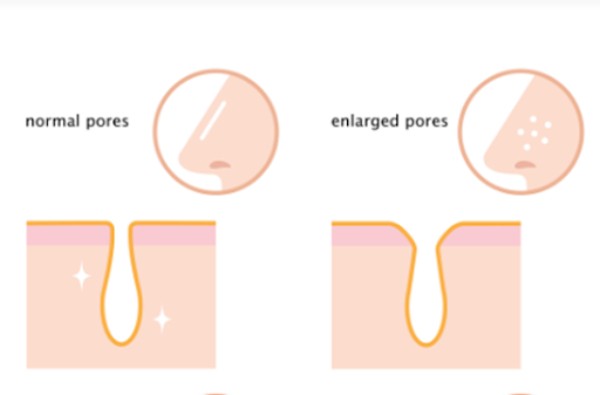 Hình bên trái là lỗ chân lông bình thường, còn bên phải là điển hình của tình trạng lỗ chân lông to