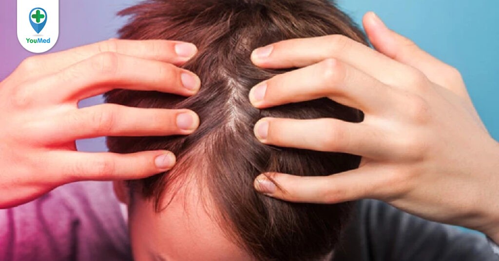 Nấm da đầu: Nguyên nhân, triệu chứng và cách điều trị