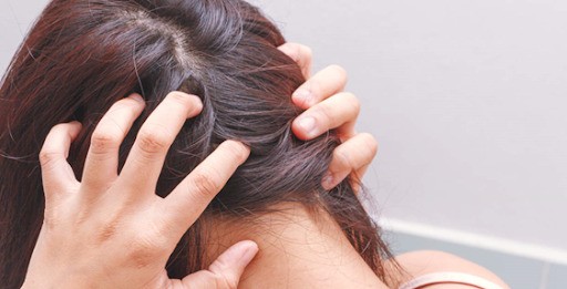 Có khá nhiều người gặp phải khổ sở vì bệnh nấm da đầu, đặc biệt là trẻ em