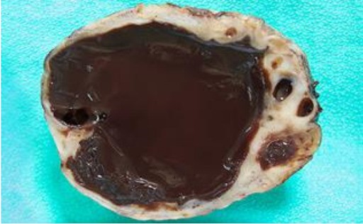 Nang lạc nội mạc tử cung chứa máu (màu nâu) trên buồng trứng