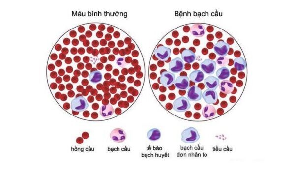 Bệnh bạch cầu làm giảm số lượng hồng cầu trong máu gây nên hiện tượng thiếu máu