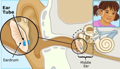 Ống thông nhĩ được đặt trên màng nhĩ giúp dẫn lưu dịch trong tai giữa và hỗ trợ thông khí hòm nhĩ