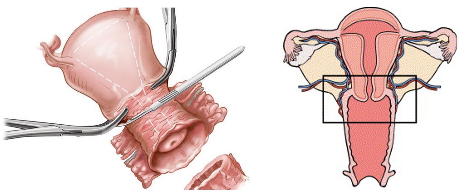 Lược đồ mô tả phẫu thuật cắt cổ tử cung