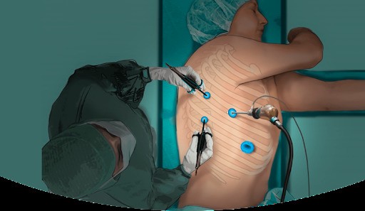 Phẫu thuật nội soi lồng ngực với hỗ trợ của video (VATS - Video-assisted thoracoscopic surgery)