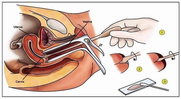 Tầm soát ung thư cổ tử cung bằng phương pháp pap – smear