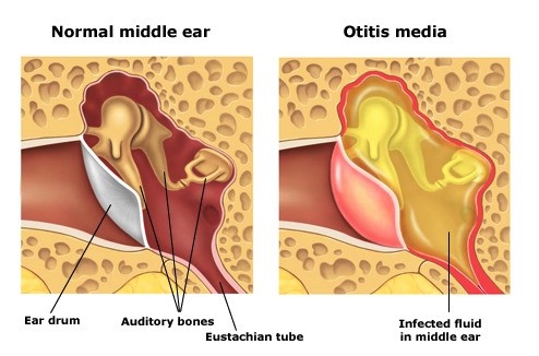 Tai giữa bình thường và tai giữa bị viêm