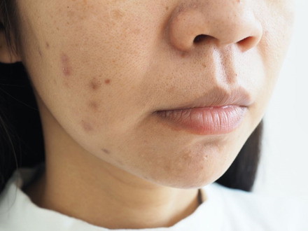Tăng sắc tố sau viêm do mụn trứng cá rất thường gặp, đặc biệt ở người có típ da tối màu