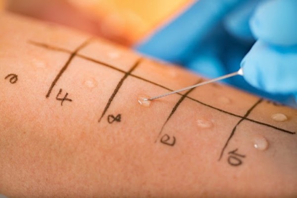 Test lẩy da giúp xác định tác nhân gây dị ứng