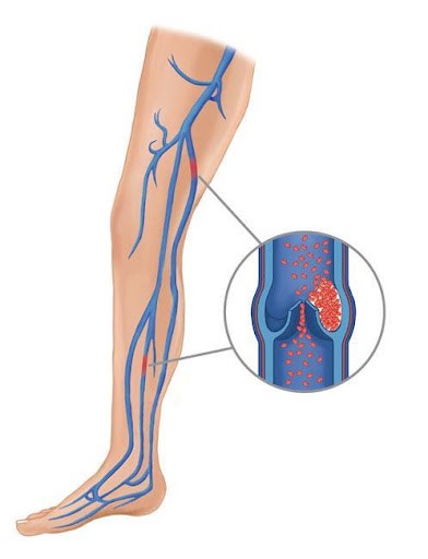 Cục máu đông có thể hình thành ở một trong những tĩnh mạch sâu của cơ thể. Các cục máu đông này có thể được tạo ra ở bất kỳ tĩnh mạch sâu nào, chúng thường được hình thành nhất ở các tĩnh mạch của xương chậu, bắp chân hoặc đùi.