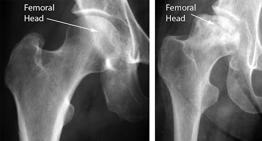 (Trái) Hình X-quang khớp háng khỏe mạnh. (Phải) Hình ảnh chỏm xương đùi đã tiến triển đến giai đoạn xẹp do chứng hoại tử chỏm xương