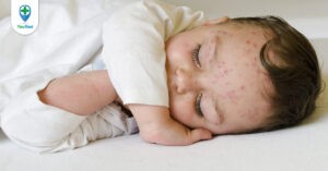 Bệnh thủy đậu ở trẻ em: nguyên nhân, triệu chứng và cách điều trị