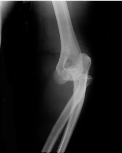 X-quang trật khớp khuỷu trên phim tư thế nghiêng