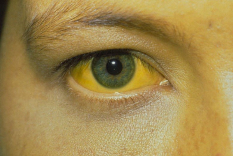Dấu hiệu vàng da, vàng mắt sẽ xuất hiện khi ung thư đã di căn đến gan