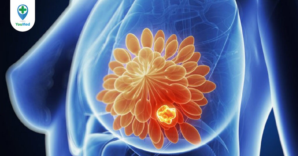 Ung thư vú di căn: dấu hiệu, chẩn đoán và điều trị