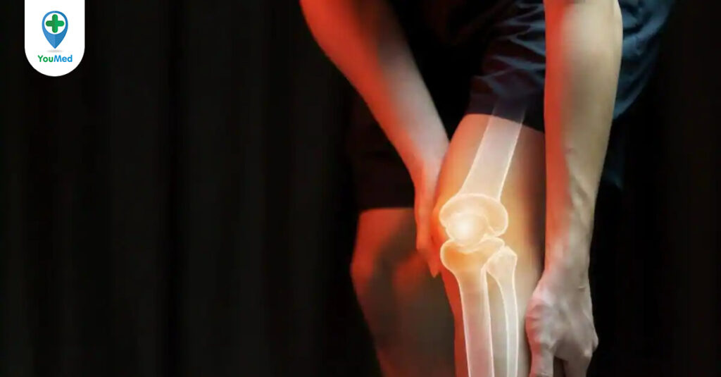 Ung thư xương: Dấu hiệu, nguyên nhân và tiên lượng bệnh