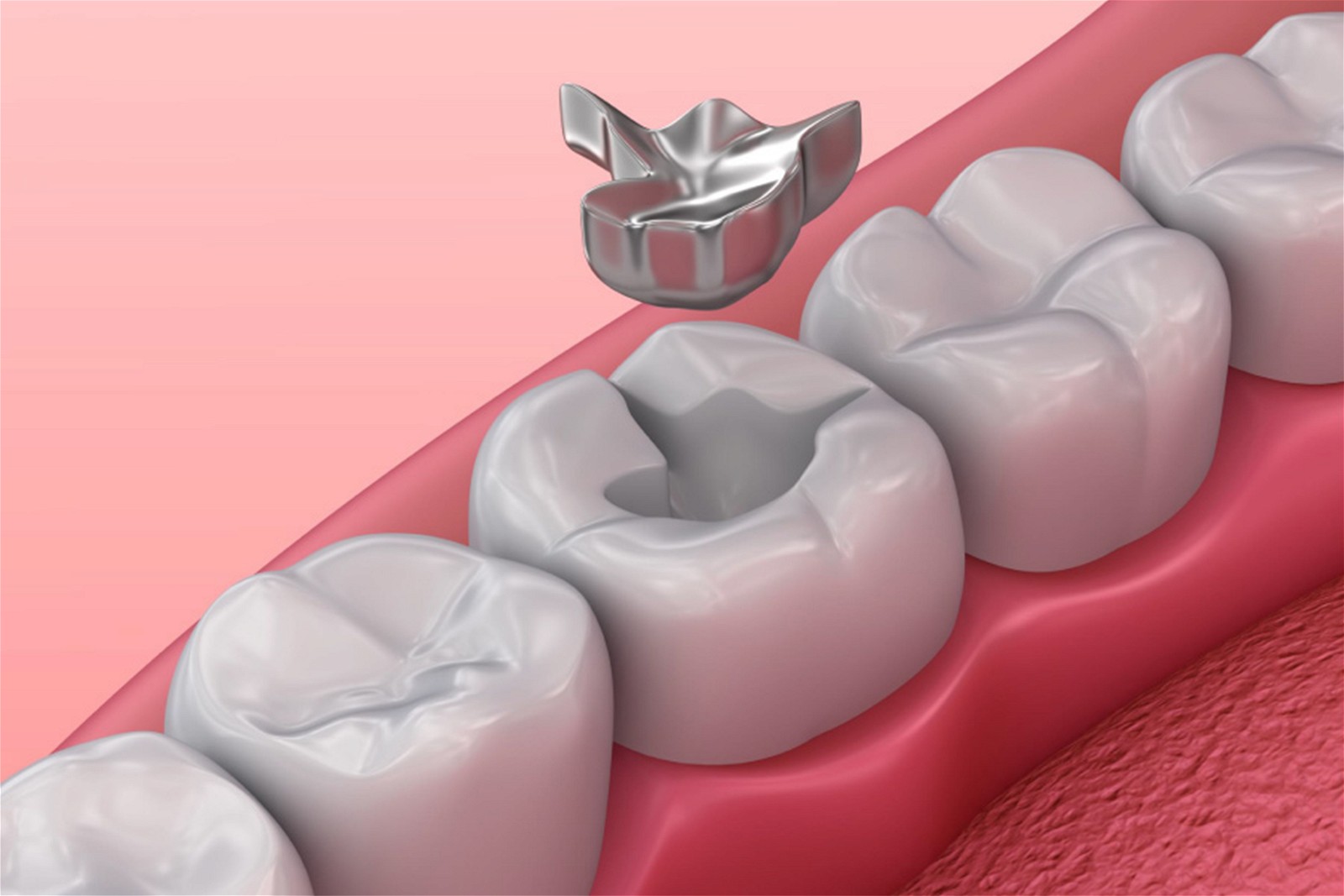 Vật liệu trám răng amalgam có độ bền và khả năng chịu lực cao