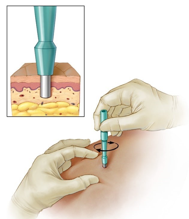 Phương pháp sinh thiết bấm lấy mẫu dưới da