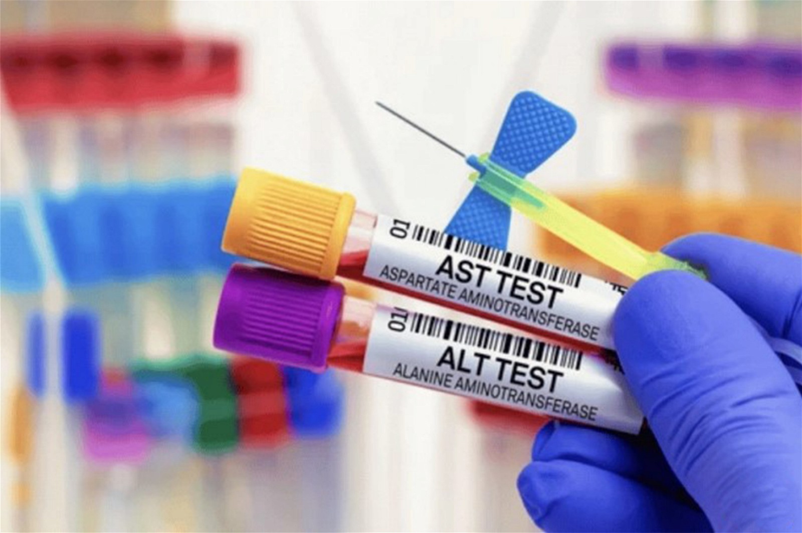 AST và ALT thuộc nhóm những xét nghiệm đánh giá tình trạng hoại tử của gan